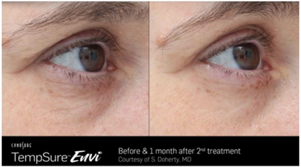 Before and After TempSure Envi Treatment for under eye wrinkles